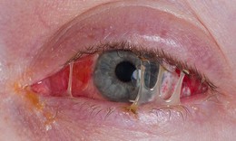 Sáng ngủ dậy hai mắt dính như keo, cụ bà phát hiện túi lệ đầy mủ