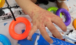TPHCM: Ca tay chân miệng tăng mạnh, nhiều trẻ đồng nhiễm virus hô hấp