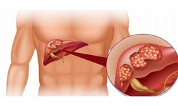 6 nhóm người có nguy cơ cao mắc xơ gan