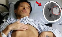 Người đàn ông đang khỏe mạnh bất ngờ đột quỵ, dấu hiệu nhiều người Việt bỏ qua