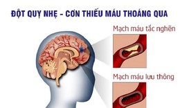 5 dấu hiệu nhận biết sớm cơn thiếu máu não thoáng qua