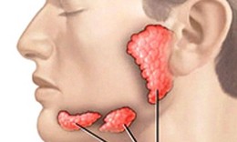 Sưng đau dưới lưỡi, cảnh giác với sỏi tuyến nước bọt
