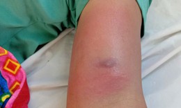 Giun rồng chui dưới da sau nhiều ngày đi rừng uống nước suối