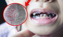 Tự nhổ răng sâu, bé trai 10 tuổi xuất huyết não nghiêm trọng