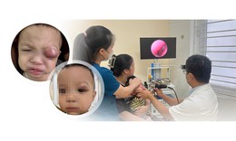 Trẻ 18 tháng tuổi nguy cơ mất thị lực do viêm xoang biến chứng
