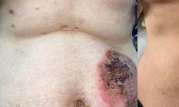 Giải cứu người phụ nữ 7 năm chung sống với các nốt bọng nước đau rát