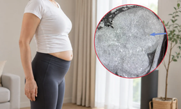 Bụng to bất thường, người phụ nữ 40 tuổi phát hiện 25 khối u xơ tử cung