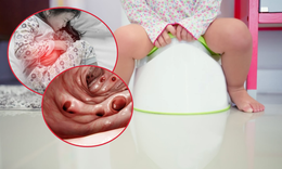 Bé gái đi ngoài ra máu kéo dài, nguyên nhân phía sau khiến gia đình bất ngờ