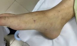 Bệnh do não mô cầu có tỷ lệ mắc thấp, tại sao vẫn xảy ra bùng phát?