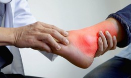Bệnh gout không chỉ do ăn uống