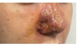 Mũi đầy mủ sau tiêm filler ở spa, bác sĩ cảnh báo biến chứng nguy hiểm