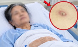 Người phụ nữ 62 tuổi phải cấp cứu chỉ vì 1 vết đốt nhỏ