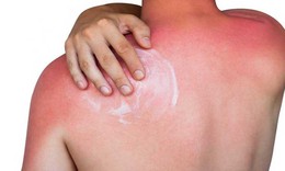 Trào lưu phơi nắng 'trị bách bệnh' có nguy cơ ung thư da