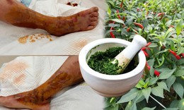 Người phụ nữ 65 tuổi hoại tử chân sau khi đắp lá ớt chữa vết thương