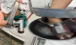 Nữ đầu bếp gặp tai nạn kinh hoàng khi xay thịt phải cắt bỏ 3 ngón tay