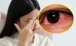Mắt trái sưng đỏ kèm đau đầu, bác sĩ phát hiện nguyên nhân ít ai ngờ
