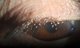Ngứa mắt nhiều ngày, kinh hãi phát hiện hàng trăm con rận mu bám kín mi mắt