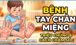 Cảnh giác bệnh tay chân miệng ở trẻ, phát hiện sớm dấu hiệu chuyển nặng