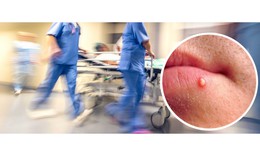 Tự nặn mụn trên mũi, nam thanh niên sốt cao, mặt sưng biến dạng vì biến chứng