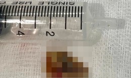 Mảnh xương 2 cm nằm sâu trong phế quản, gây tắc phổi và nhiều ổ mủ
