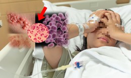 Đau họng uống thuốc mãi không khỏi, đi khám bất ngờ phát hiện mắc bệnh lậu