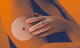 Vaccine ung thư mới giúp giảm 42% nguy cơ tái phát u hắc tố