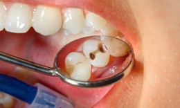 4 thói quen thường gặp có thể khiến răng sâu nhanh hơn