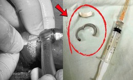 Đeo vòng dương vật để tăng khoái cảm, nam thanh niên 28 tuổi nhập viện nguy kịch