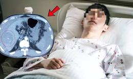 Chạy bộ kiểu này, người đàn ông bất ngờ tử vong vì vỡ khối ung thư gan