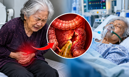 Tự thụt tháo vì táo bón, cụ bà 81 tuổi vỡ đại tràng, nguy kịch