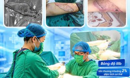 Ghép da cho bệnh nhân bỏng bô xe máy