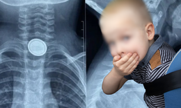 Bé 3 tuổi nuốt pin cúc áo, thực quản bị ăn mòn nghiêm trọng