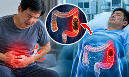 Đau bụng âm ỉ, người đàn ông nhập viện khi đại tràng đã tắc hoàn toàn