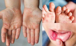 TPHCM: Tay chân miệng tăng gần 48%, sốt xuất huyết vẫn ở mức cao