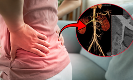 Đi khám vì đau hông lưng, phát hiện túi phình động mạch thận kích thước lớn