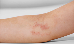 Xem nhẹ viêm da có thể bị tổn thương, nhiễm trùng nặng