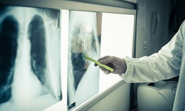 Bộ Y tế: Ưu tiên phân bổ ngân sách địa phương cho công tác phòng, chống lao