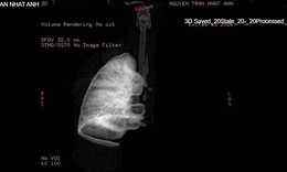 Gắp mảnh nhựa sắc nhọn, cứu bé 7 tuổi xẹp hoàn toàn phổi trái
