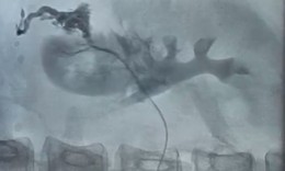 Bệnh viện 19-8 cấp cứu ca vỡ thận nguy kịch