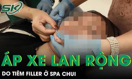Tiêm filler ở spa chui, cô gái trẻ nhập viện vì áp xe lan rộng 