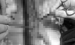 Dựng cây nêu vướng dây điện, người phụ nữ nguy cơ mất cẳng tay