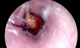 Nhờ tiệm cắt tóc lấy dị vật, bệnh nhân bị xung huyết ống tai