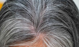 Các giải pháp làm chậm và hỗ trợ phục hồi tóc bạc sớm