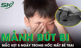 Gắp đoạn bút bi nhựa mắc kẹt 5 ngày trong hốc mắt bé trai
