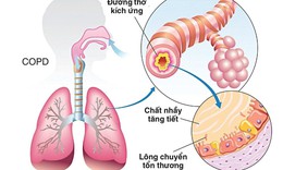 Phân biệt bệnh hen và COPD