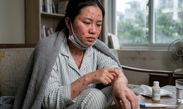 Cách điều trị bệnh thủy đậu tại nhà, ngăn ngừa sẹo