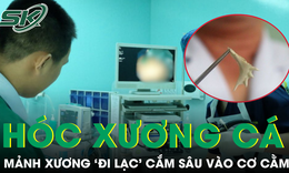Phẫu thuật lấy xương cá 'trú ẩn' 10 ngày trong cằm bệnh nhân