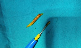 Nam bệnh nhân nhập viện cấp cứu vì xương cá kích thước lớn 'đi lạc' xuống... ruột non