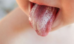 Nấm miệng có lây không?