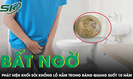 Phát hiện sỏi bàng quang khổng lồ khi bệnh nhân đi khám bệnh khác